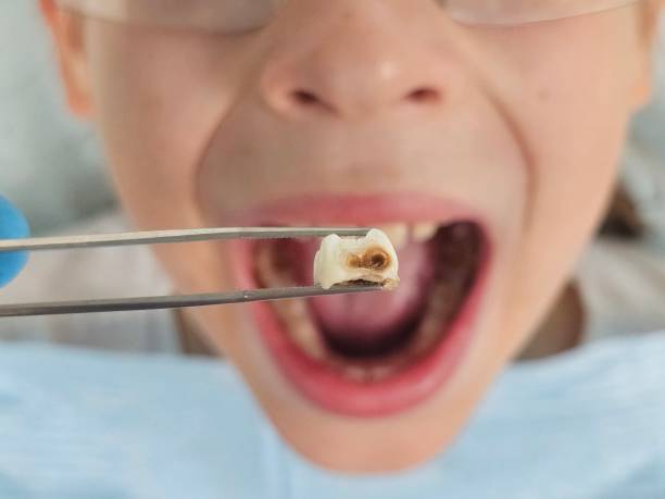 Best Knocked-Out Tooth Emergency  in East Missoula, MT